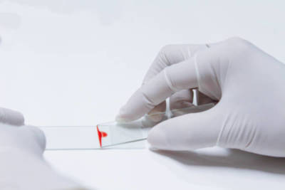 Blutausstrich auf Objektträger für einen Färbeautomaten für das Injektionsverfahren